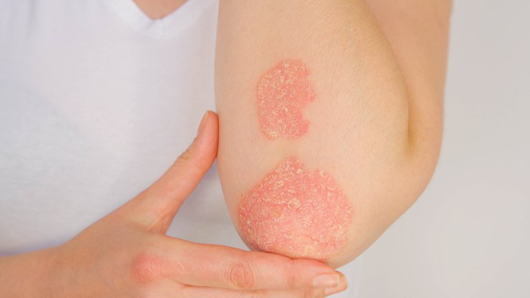 La-psoriasis-es-una-enfermedad-de-la-piel-que-afecta-a-millones-de-personas-en-todo-el-mundo